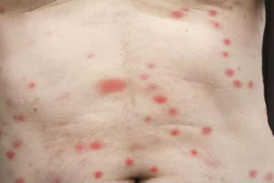A trail of bed bug bites on the stomach of a man